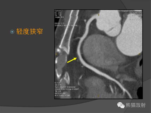 【PPT】冠状动脉斑块评估、管腔狭窄程度分级
