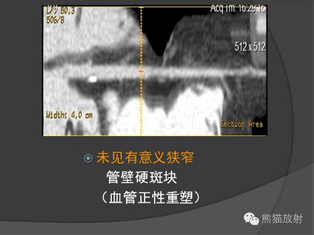 【PPT】冠状动脉斑块评估、管腔狭窄程度分级
