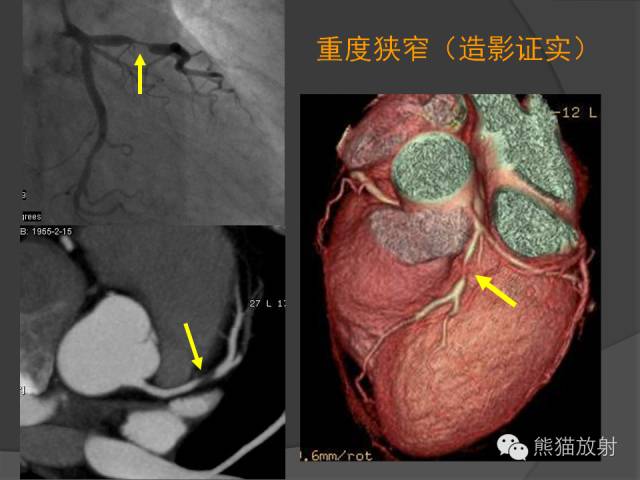 【PPT】冠状动脉斑块评估、管腔狭窄程度分级
