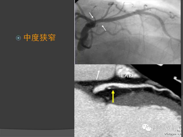 【PPT】冠状动脉斑块评估、管腔狭窄程度分级