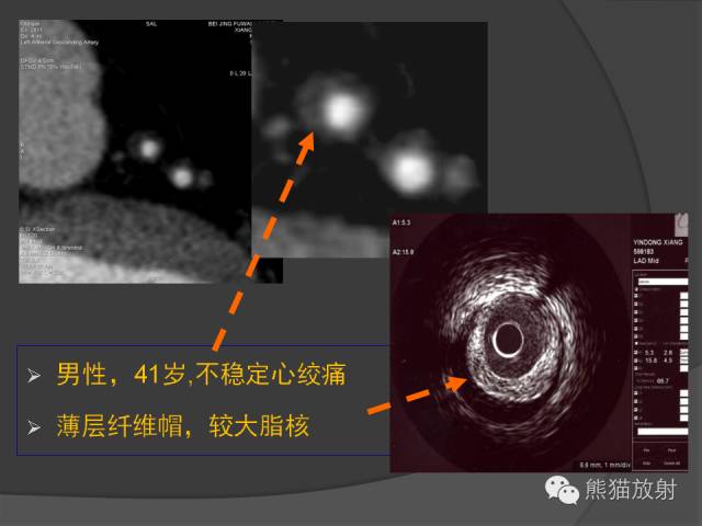 【PPT】冠状动脉斑块评估、管腔狭窄程度分级