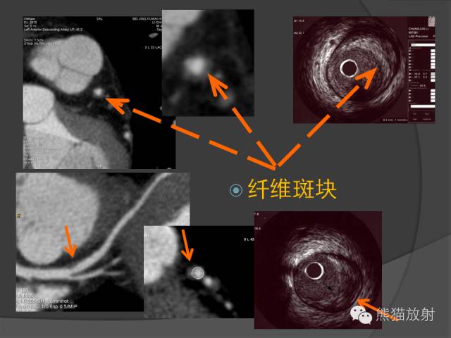 【PPT】冠状动脉斑块评估、管腔狭窄程度分级
