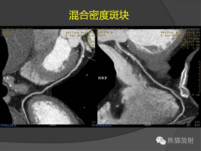 【PPT】冠状动脉斑块评估、管腔狭窄程度分级