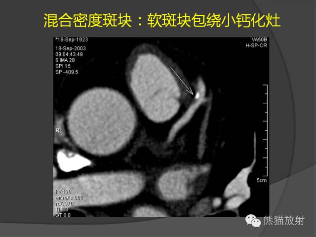 【PPT】冠状动脉斑块评估、管腔狭窄程度分级