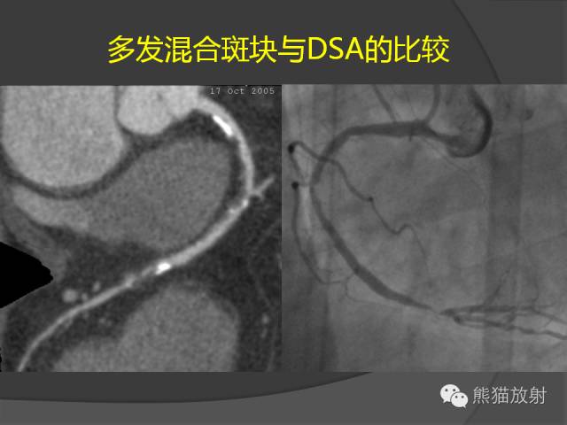 【PPT】冠状动脉斑块评估、管腔狭窄程度分级