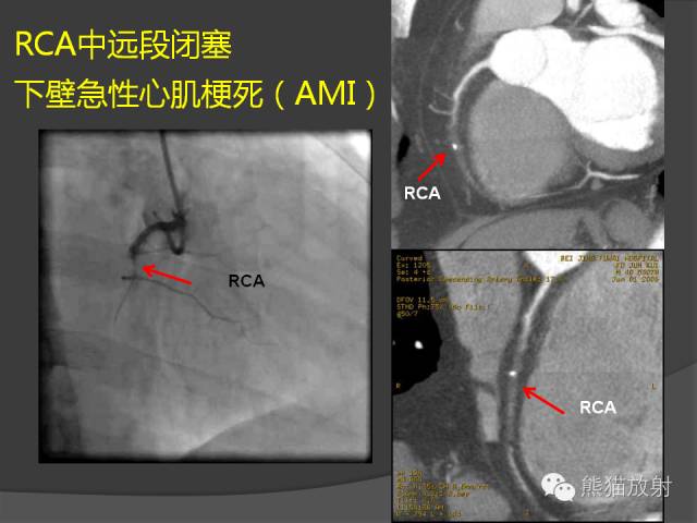 【PPT】冠状动脉斑块评估、管腔狭窄程度分级