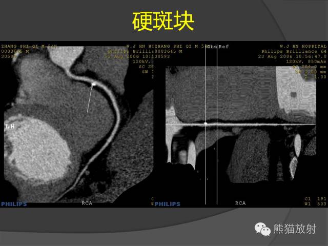 【PPT】冠状动脉斑块评估、管腔狭窄程度分级