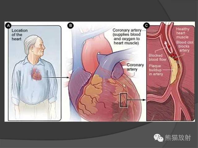【PPT】冠状动脉斑块评估、管腔狭窄程度分级