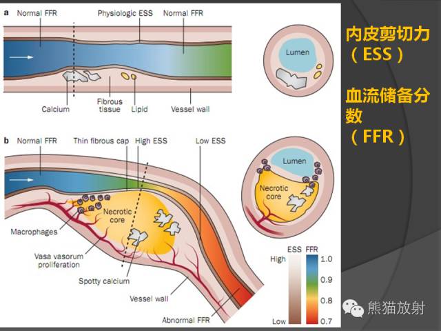 【PPT】冠状动脉斑块评估、管腔狭窄程度分级