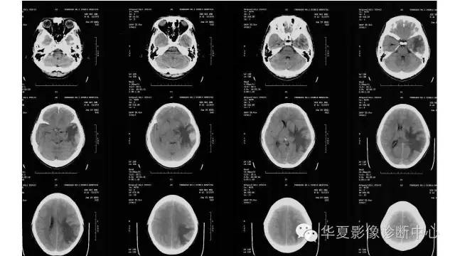 【病例】左颞叶恶性黑色素瘤1例MR影像分析