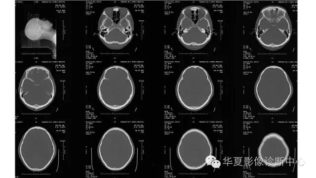 【病例】左颞叶恶性黑色素瘤1例MR影像分析