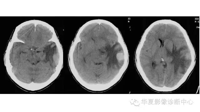 【病例】左颞叶恶性黑色素瘤1例MR影像分析