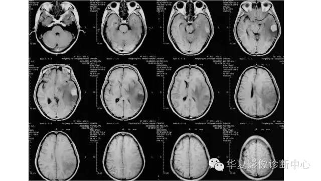 【病例】左颞叶恶性黑色素瘤1例MR影像分析