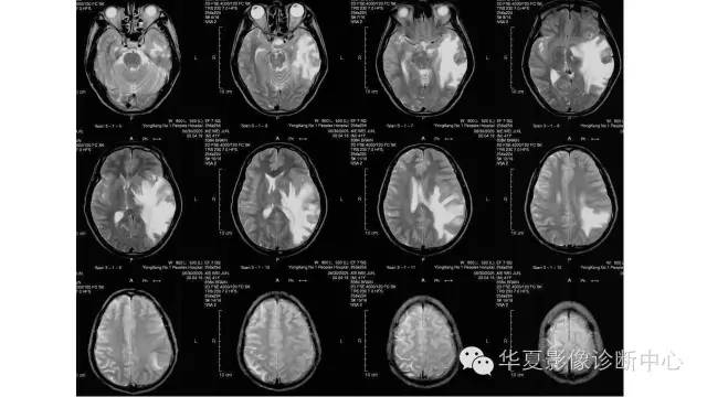 【病例】左颞叶恶性黑色素瘤1例MR影像分析