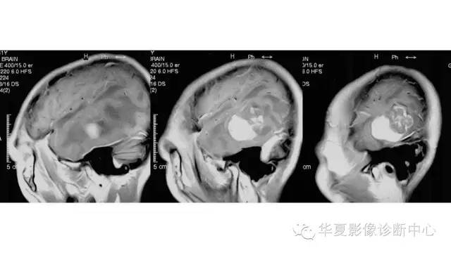 【病例】左颞叶恶性黑色素瘤1例MR影像分析