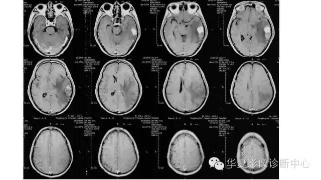 【病例】左颞叶恶性黑色素瘤1例MR影像分析