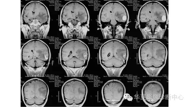 【病例】左颞叶恶性黑色素瘤1例MR影像分析