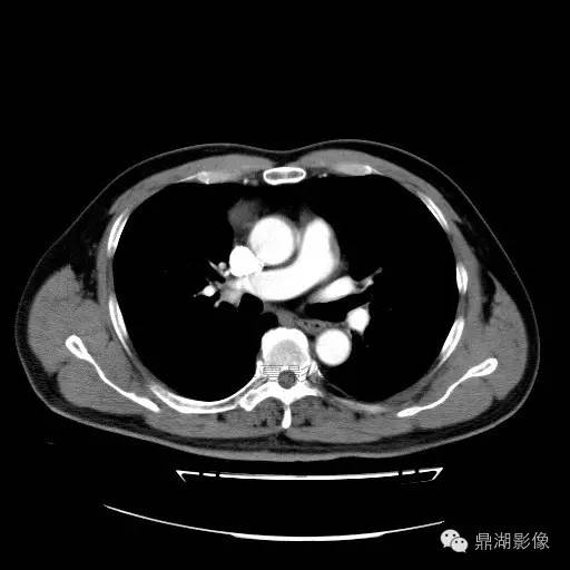 【病例】前纵隔胸腺囊肿1例CT影像表现 【病例】前纵隔胸腺囊肿1例CT影像表现