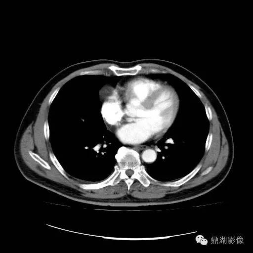 【病例】前纵隔胸腺囊肿1例CT影像表现 【病例】前纵隔胸腺囊肿1例CT影像表现