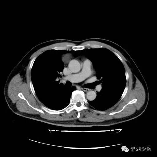 【病例】前纵隔胸腺囊肿1例CT影像表现 【病例】前纵隔胸腺囊肿1例CT影像表现