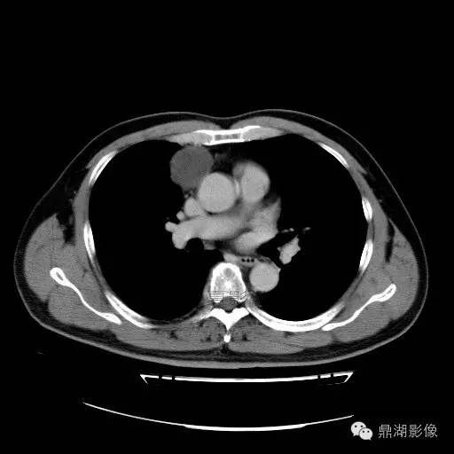【病例】前纵隔胸腺囊肿1例CT影像表现 【病例】前纵隔胸腺囊肿1例CT影像表现