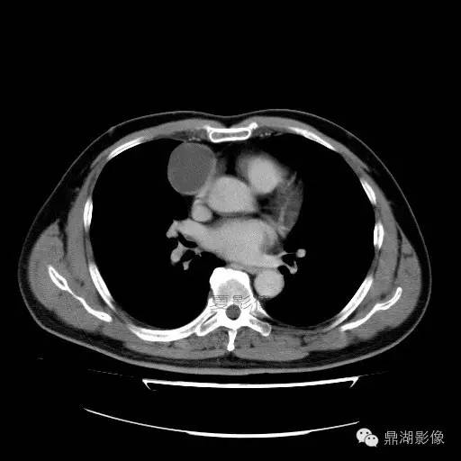 【病例】前纵隔胸腺囊肿1例CT影像表现 【病例】前纵隔胸腺囊肿1例CT影像表现