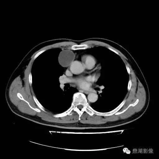【病例】前纵隔胸腺囊肿1例CT影像表现 【病例】前纵隔胸腺囊肿1例CT影像表现