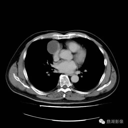 【病例】前纵隔胸腺囊肿1例CT影像表现 【病例】前纵隔胸腺囊肿1例CT影像表现