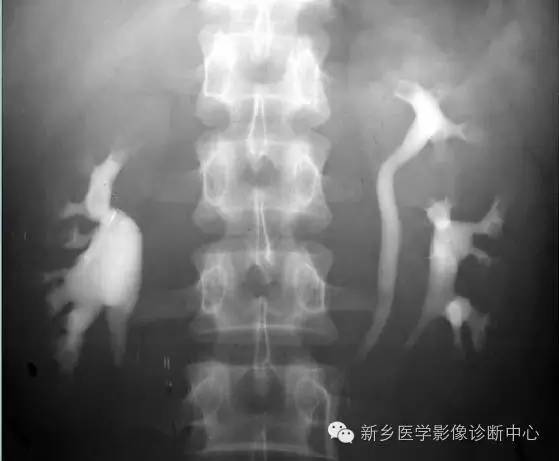 额外肾