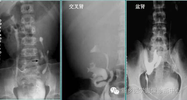 额外肾 额外肾