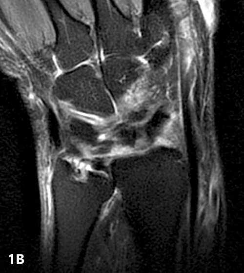 【病例】类风湿关节炎1例MRI诊断分析 【病例】类风湿关节炎1例MRI诊断分析