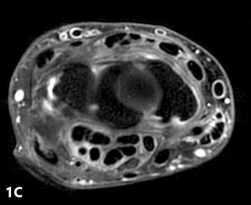 【病例】类风湿关节炎1例MRI诊断分析 【病例】类风湿关节炎1例MRI诊断分析