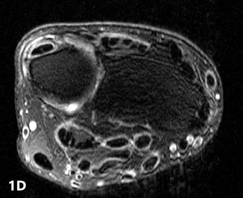 【病例】类风湿关节炎1例MRI诊断分析 【病例】类风湿关节炎1例MRI诊断分析