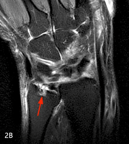 【病例】类风湿关节炎1例MRI诊断分析 【病例】类风湿关节炎1例MRI诊断分析