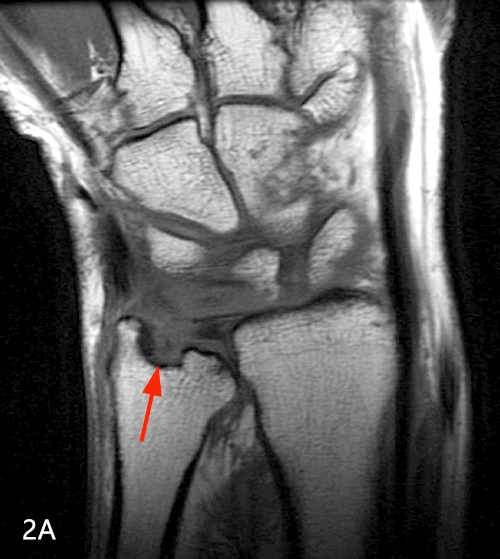 【病例】类风湿关节炎1例MRI诊断分析 【病例】类风湿关节炎1例MRI诊断分析
