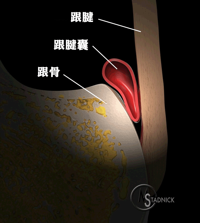 【病例】类风湿关节炎1例MRI诊断分析 【病例】类风湿关节炎1例MRI诊断分析