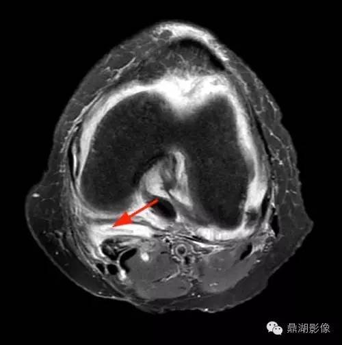 【病例】类风湿关节炎1例MRI诊断分析 【病例】类风湿关节炎1例MRI诊断分析