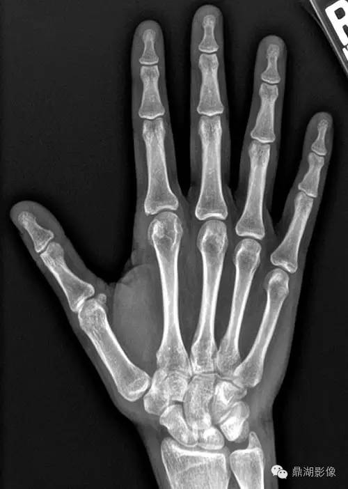 【病例】类风湿关节炎1例MRI诊断分析 【病例】类风湿关节炎1例MRI诊断分析