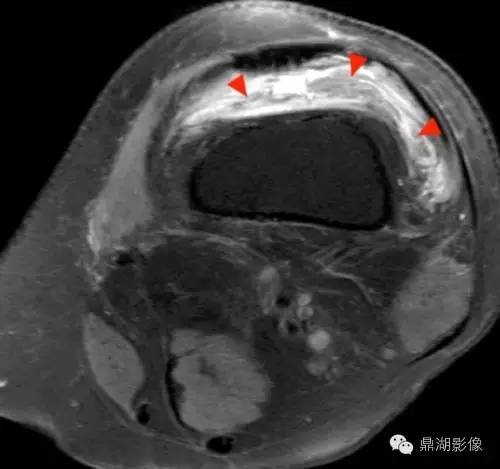 【病例】类风湿关节炎1例MRI诊断分析 【病例】类风湿关节炎1例MRI诊断分析