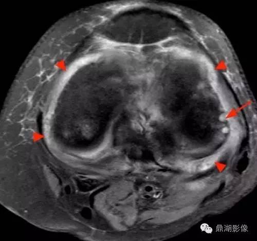 【病例】类风湿关节炎1例MRI诊断分析 【病例】类风湿关节炎1例MRI诊断分析