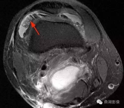 【病例】类风湿关节炎1例MRI诊断分析 【病例】类风湿关节炎1例MRI诊断分析