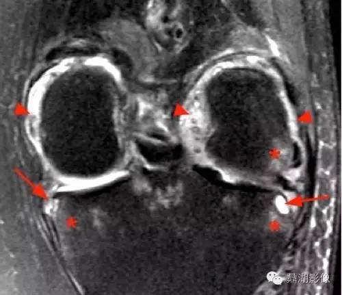 【病例】类风湿关节炎1例MRI诊断分析 【病例】类风湿关节炎1例MRI诊断分析