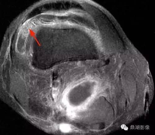 【病例】类风湿关节炎1例MRI诊断分析 【病例】类风湿关节炎1例MRI诊断分析