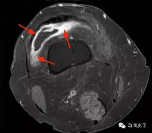 【病例】类风湿关节炎1例MRI诊断分析 【病例】类风湿关节炎1例MRI诊断分析