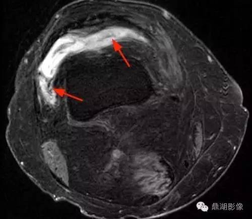 【病例】类风湿关节炎1例MRI诊断分析 【病例】类风湿关节炎1例MRI诊断分析