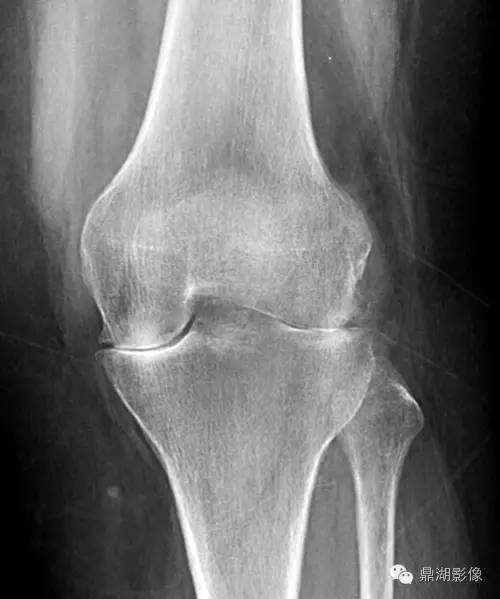 【病例】类风湿关节炎1例MRI诊断分析 【病例】类风湿关节炎1例MRI诊断分析