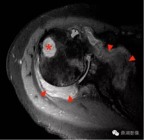 【病例】类风湿关节炎1例MRI诊断分析 【病例】类风湿关节炎1例MRI诊断分析