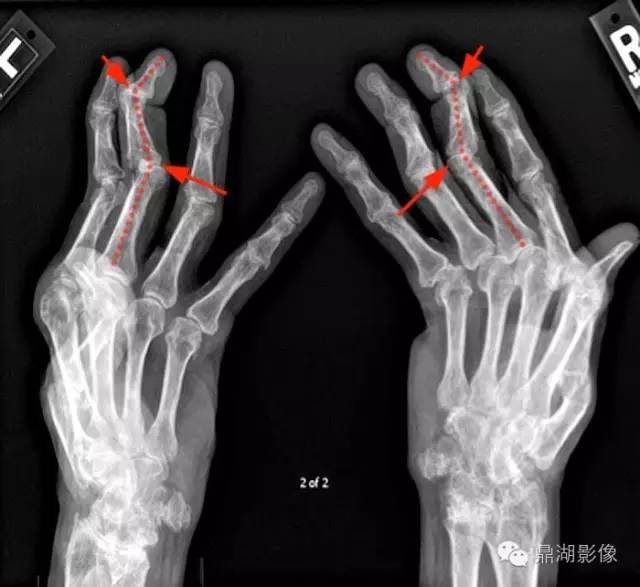 【病例】类风湿关节炎1例MRI诊断分析 【病例】类风湿关节炎1例MRI诊断分析