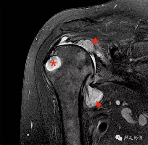【病例】类风湿关节炎1例MRI诊断分析 【病例】类风湿关节炎1例MRI诊断分析