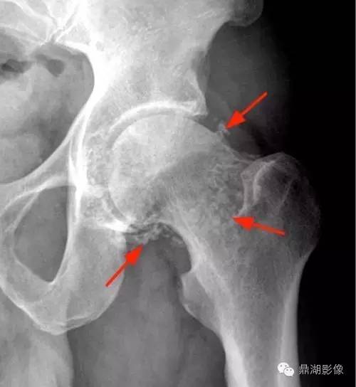 【病例】类风湿关节炎1例MRI诊断分析 【病例】类风湿关节炎1例MRI诊断分析
